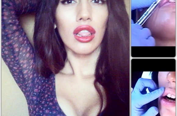 VIDEO kadras: MY NEW LOOK! My Lip Injection Experience