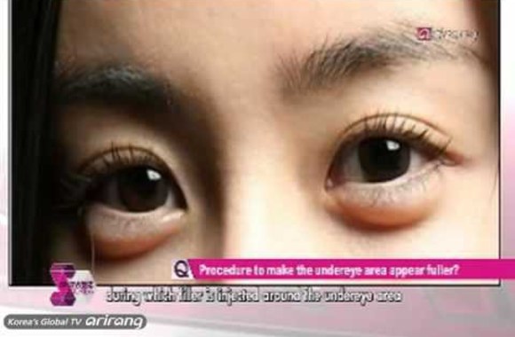 VIDEO kadras: Maišeliai po akimis