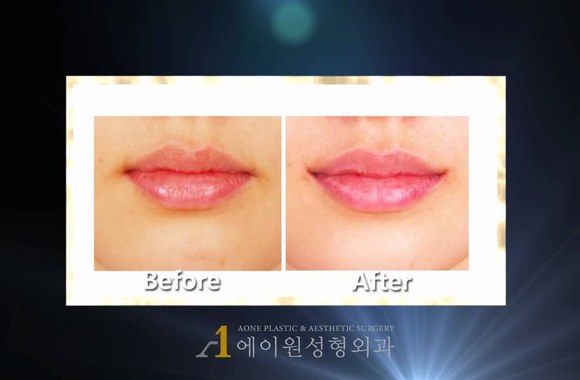 VIDEO kadras: Plastinės lūpų kampučių operacijos