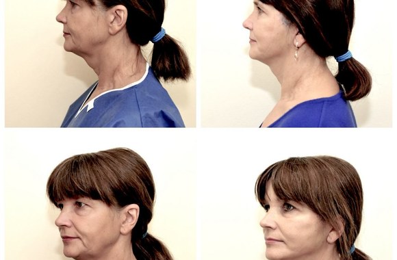 Rima Vaniarchina prieš pokčius