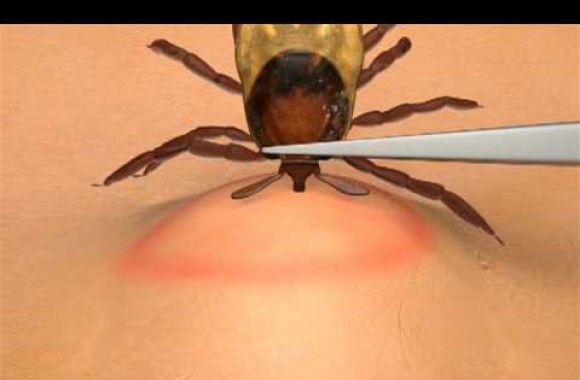 VIDEO kadras: Kaip teisingai pašalinti įsisiurbusią erkę