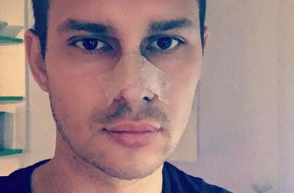 Algimantas Mingaila-Soliaris po plastinės nosies operacijos