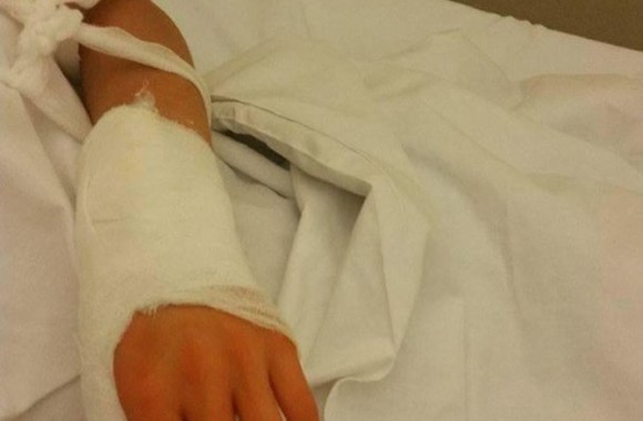 Sandros Navickaitės ranka po operacijos