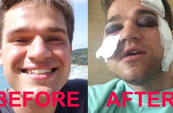 near-death-crash-10000-surgery-in-thailand