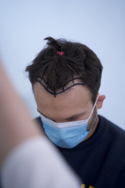 Vaidas Baumila ryžosi plaukų transplantacijai