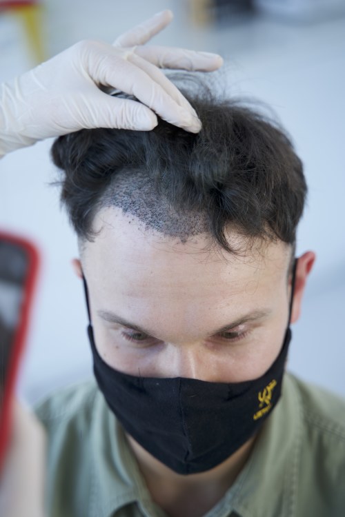 Vaidas Baumila ryžosi plaukų transplantacijai