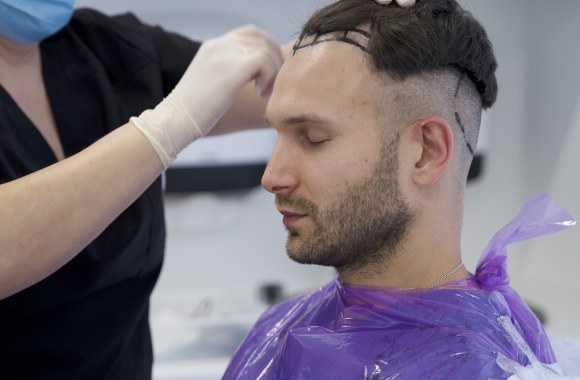 Vaidas Baumila ryžosi plaukų transplantacijai