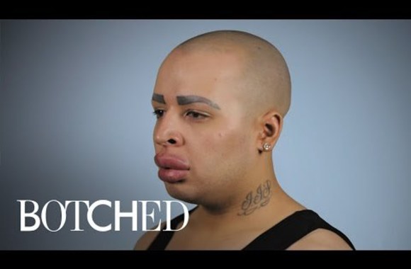 VIDEO kadras: Can \"Botched\" Doctors Help Patient With Ginormous Lips? | Botched | E!