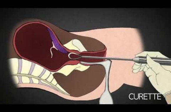 2nd-trimester-abortion-procedure-dr-anthony-levatino-former-abortionist-turns-pro-life